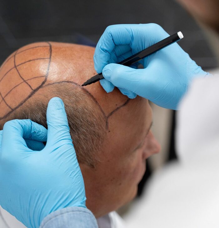hair transplant turkey
