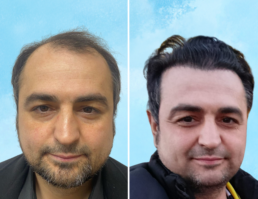 DHI Saç Ekimi ve Modern Tedavi Yöntemleri